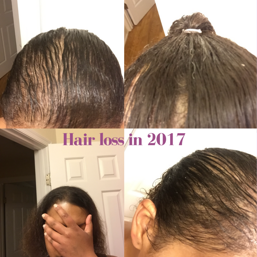 Five steps to hair regrowth after loss - Grace & Grapes