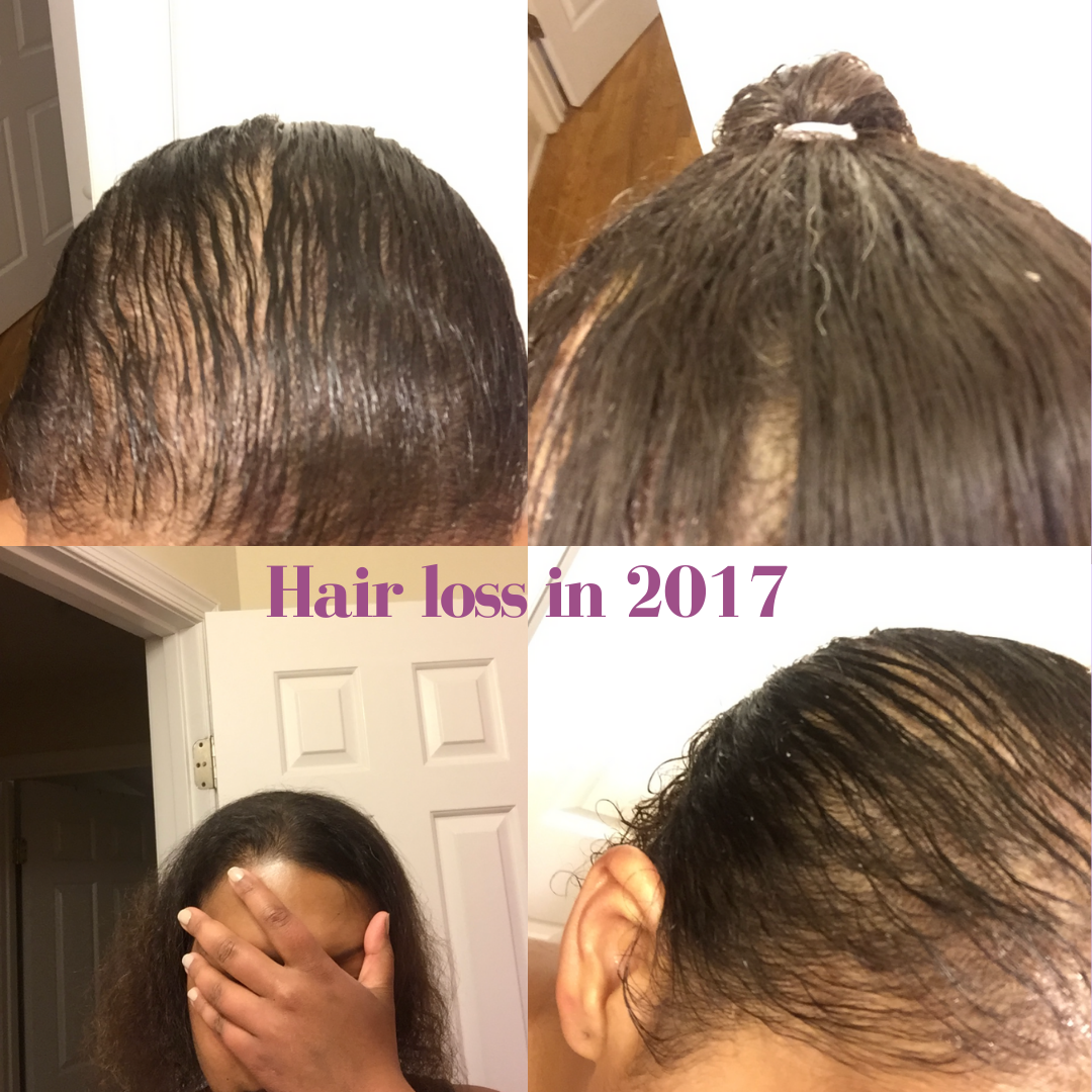 Five Steps To Hair Regrowth After Loss - Grace & Grapes